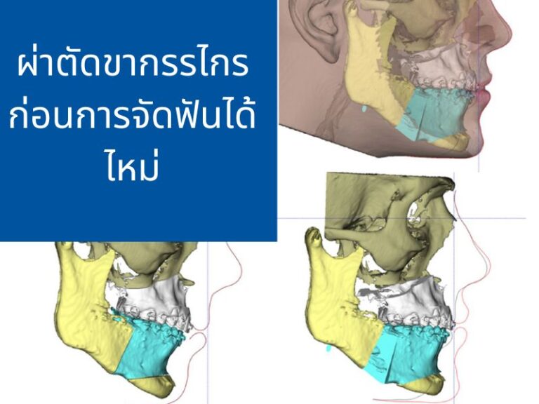 ผ่าตัดขากรรไกรก่อนการจัดฟันได้หรือไม่ พร้อมข้อดี ข้อเสีย