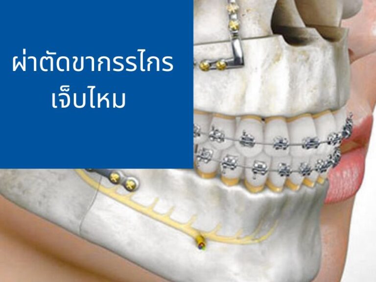 ผ่าตัดขากรรไกรเจ็บไหม จัดฟันอย่างเดียวได้หรือไม่