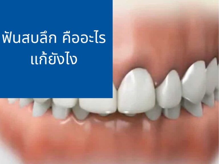 ฟันสบลึก ยิ้มไม่เห็นฟันล่าง คืออะไร แก้ยังไง