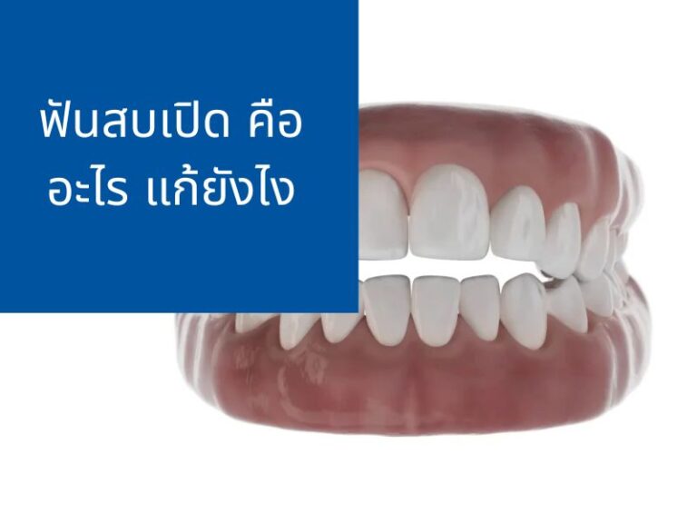 ฟันสบเปิด (Open Bite) ฟันไม่สบกัน คืออะไร แก้ยังไง