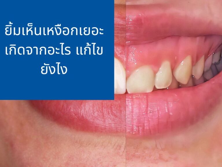 ยิ้มเห็นเหงือกเยอะ เกิดจากอะไร แก้ไขยังไง