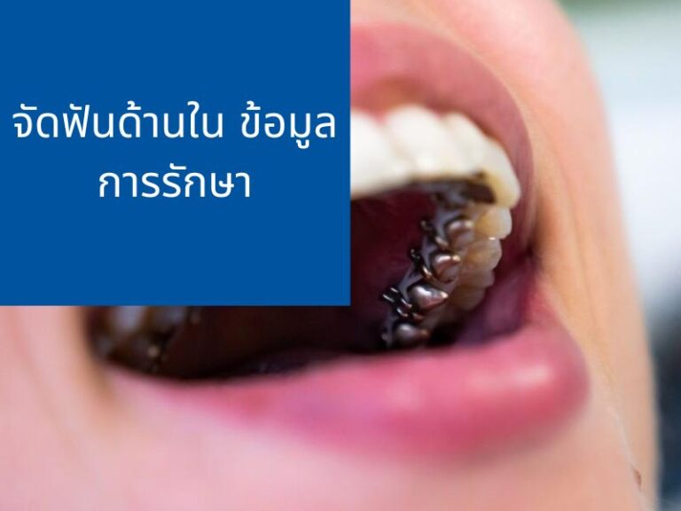 จัดฟันด้านใน (Lingual) ข้อดี ข้อเสีย พร้อมข้อมูลการจัดฟัน