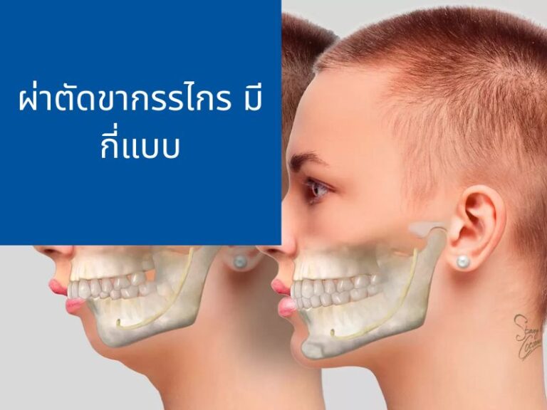 6 ประเภทของการผ่าตัดขากรรไกร