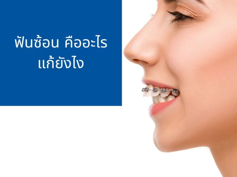 ฟันซ้อนคืออะไร วิธีแก้ทำยังไง จัดฟันได้หรือไม่